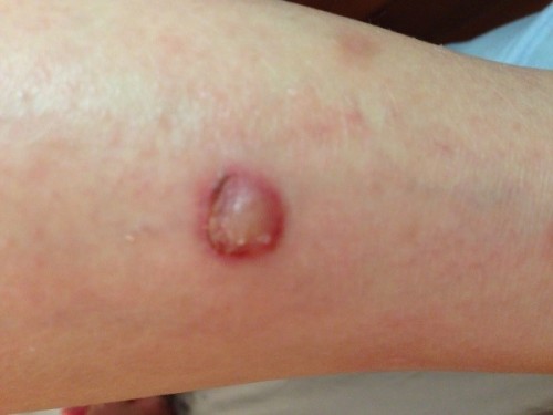 Necrotic skin delay reaction caused by mosquito bites